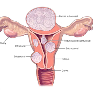 relevance_fibroid