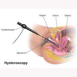 hysteroscopy