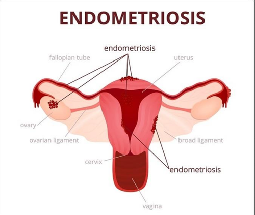 endometriosis