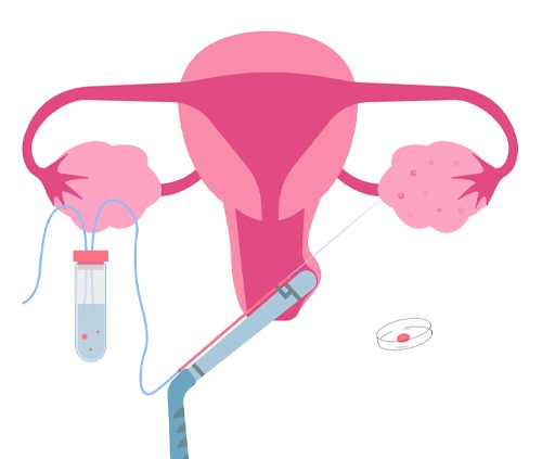 Transvaginal Oocyte Retrieval