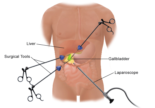 Laparoscopy Jalandhar, Laparoscopic Weight Loss Surgery Punjab, Laparoscopic Surgeon in Jalandhar Punjab