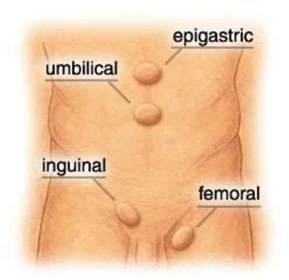 Laparoscopic Inguinal Hernia Repair Surgery