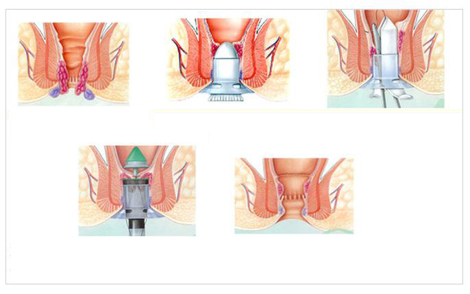 Uterus Removal Surgery in Jalandhar, Punjab